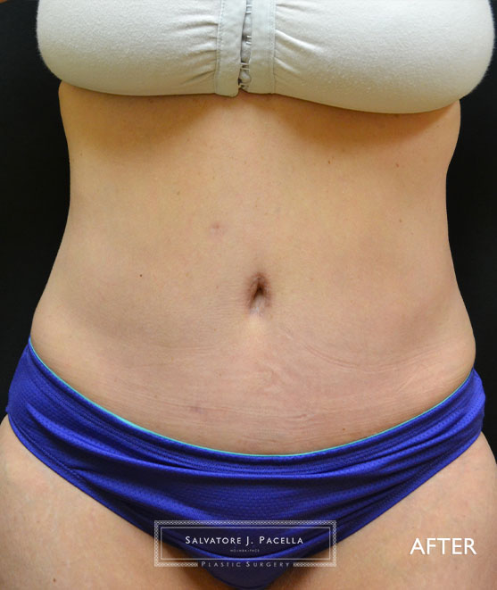 San Diego | La Jolla | Carmel Valley | Del Mar | Encinitas | Plastic Surgery | Body Contouring | Tummy Tuck | Abdominoplasty | Top Plastic Surgeon