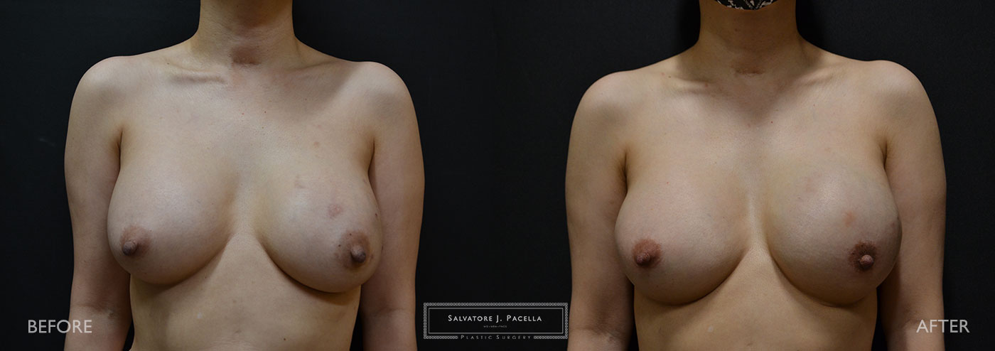 Scripps Plastic Surgeon | Breast Reconstruction | Mastectomy | Breast Implants | Del Mar | San Diego | La Jolla | Plastic Surgery | Reconstructive Surgery | Breast Surgery | Tissue expanders | Artoura | Mentor breast implants | Sientra breast implants