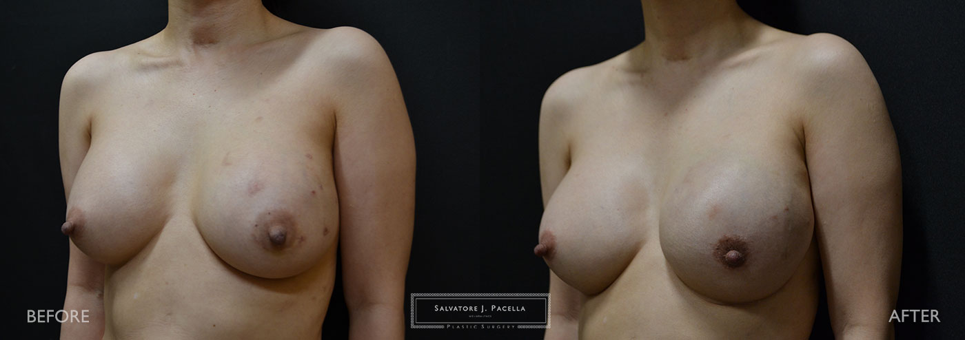 Scripps Plastic Surgeon | Breast Reconstruction | Mastectomy | Breast Implants | Del Mar | San Diego | La Jolla | Plastic Surgery | Reconstructive Surgery | Breast Surgery | Tissue expanders | Artoura | Mentor breast implants | Sientra breast implants