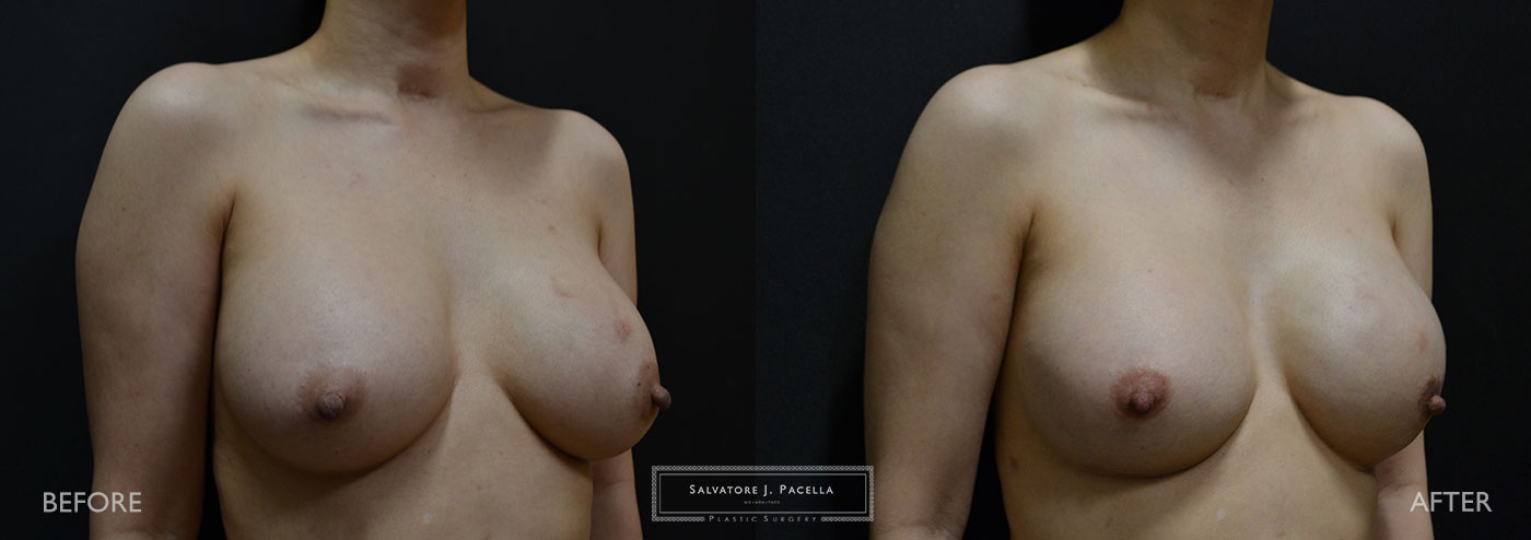 Scripps Plastic Surgeon | Breast Reconstruction | Mastectomy | Breast Implants | Del Mar | San Diego | La Jolla | Plastic Surgery | Reconstructive Surgery | Breast Surgery | Tissue expanders | Artoura | Mentor breast implants | Sientra breast implants