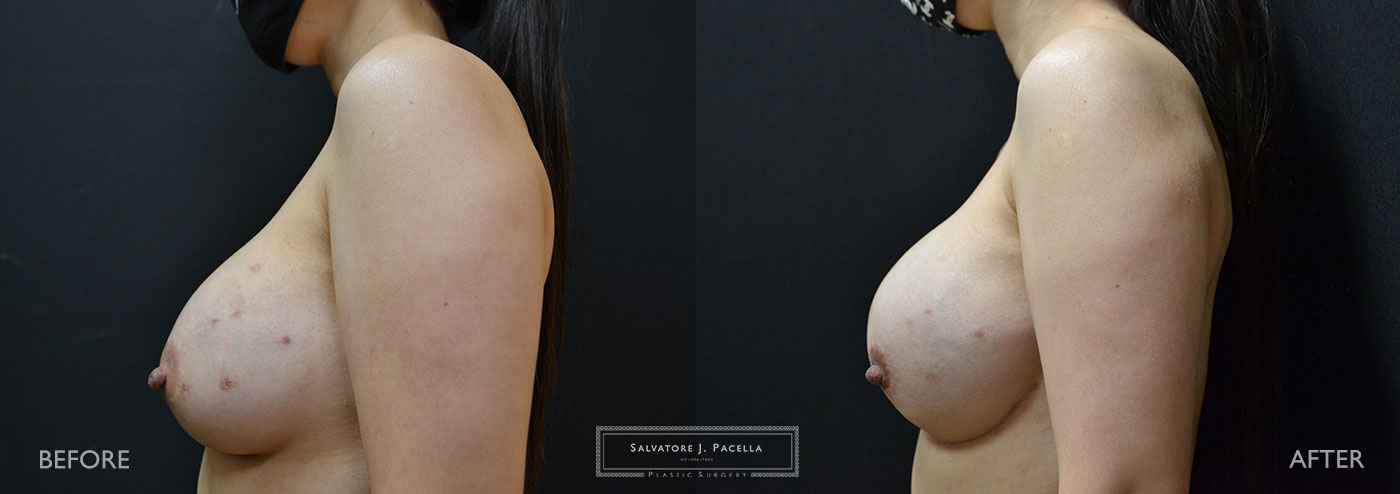 Scripps Plastic Surgeon | Breast Reconstruction | Mastectomy | Breast Implants | Del Mar | San Diego | La Jolla | Plastic Surgery | Reconstructive Surgery | Breast Surgery | Tissue expanders | Artoura | Mentor breast implants | Sientra breast implants