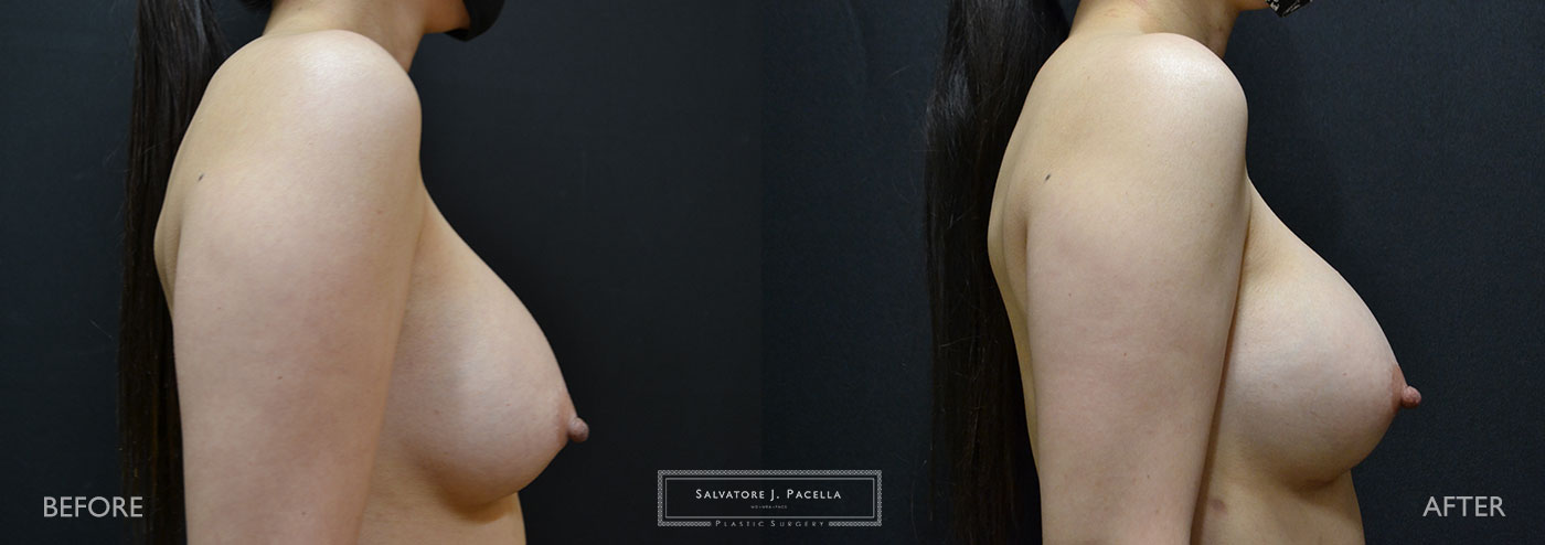 Scripps Plastic Surgeon | Breast Reconstruction | Mastectomy | Breast Implants | Del Mar | San Diego | La Jolla | Plastic Surgery | Reconstructive Surgery | Breast Surgery | Tissue expanders | Artoura | Mentor breast implants | Sientra breast implants