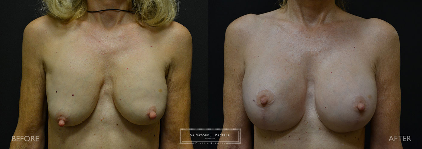 Scripps Plastic Surgeon | Plastic Surgery | Cosmetic Surgery | Breast Revision | Mastopexy | Sientra breast implants | Del Mar | San Diego | La Jolla | Breast Implants