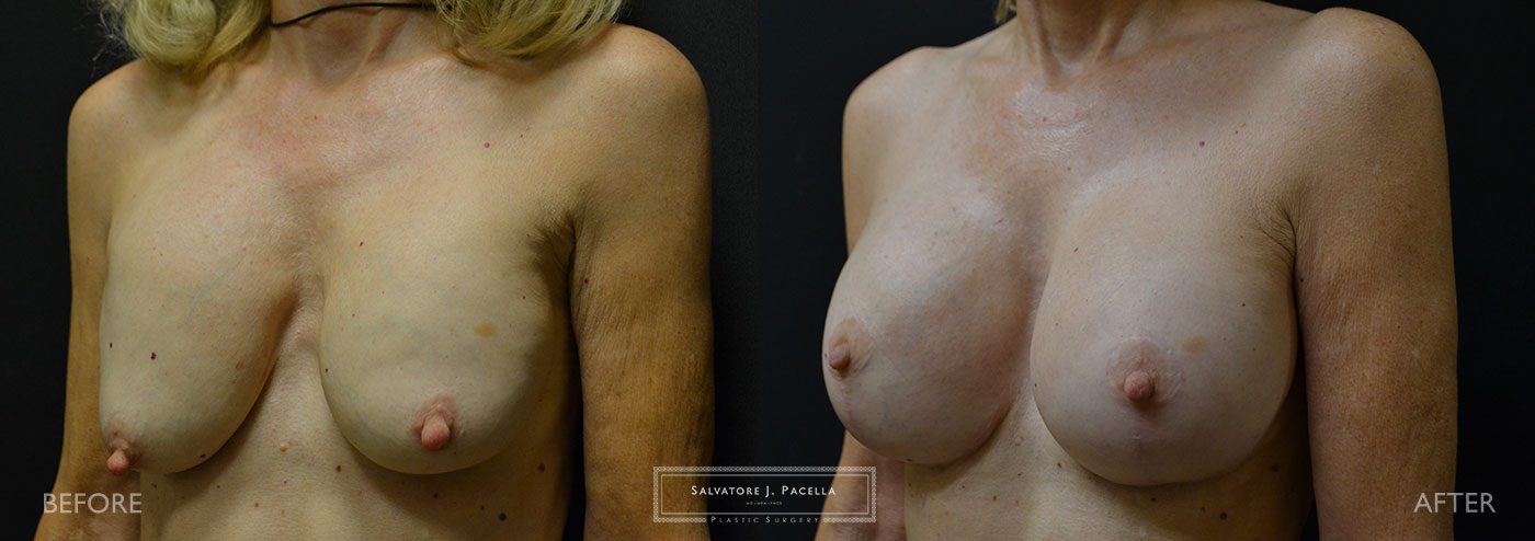 Scripps Plastic Surgeon | Plastic Surgery | Cosmetic Surgery | Breast Revision | Mastopexy | Sientra breast implants | Del Mar | San Diego | La Jolla | Breast Implants