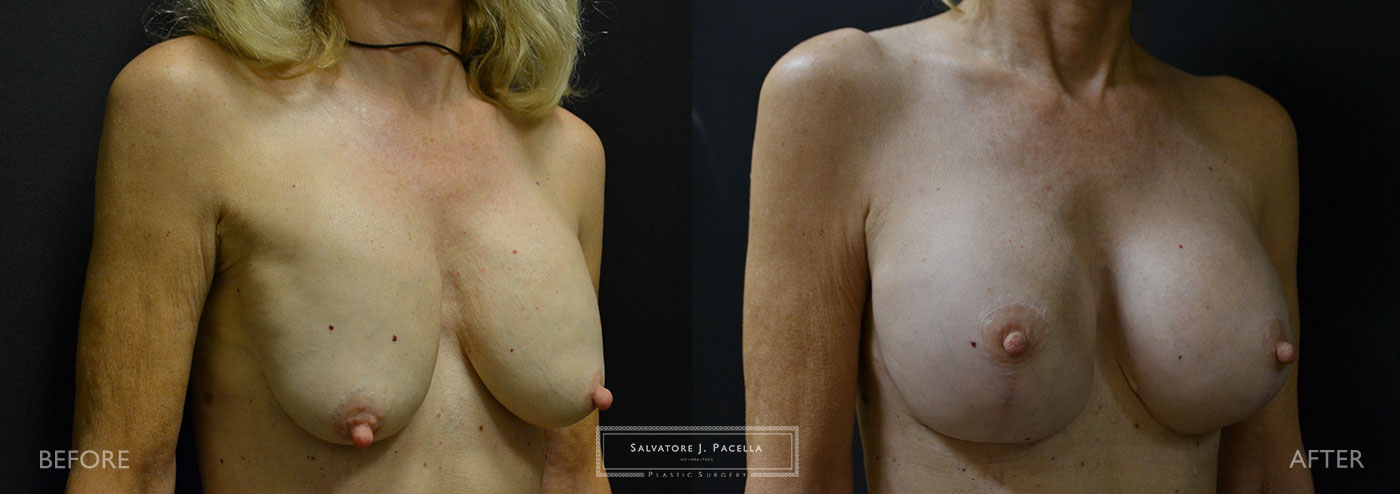 Scripps Plastic Surgeon | Plastic Surgery | Cosmetic Surgery | Breast Revision | Mastopexy | Sientra breast implants | Del Mar | San Diego | La Jolla | Breast Implants