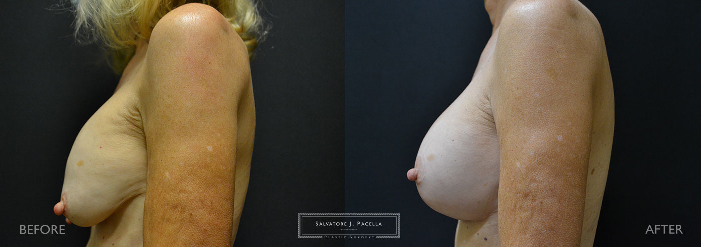 Scripps Plastic Surgeon | Plastic Surgery | Cosmetic Surgery | Breast Revision | Mastopexy | Sientra breast implants | Del Mar | San Diego | La Jolla | Breast Implants