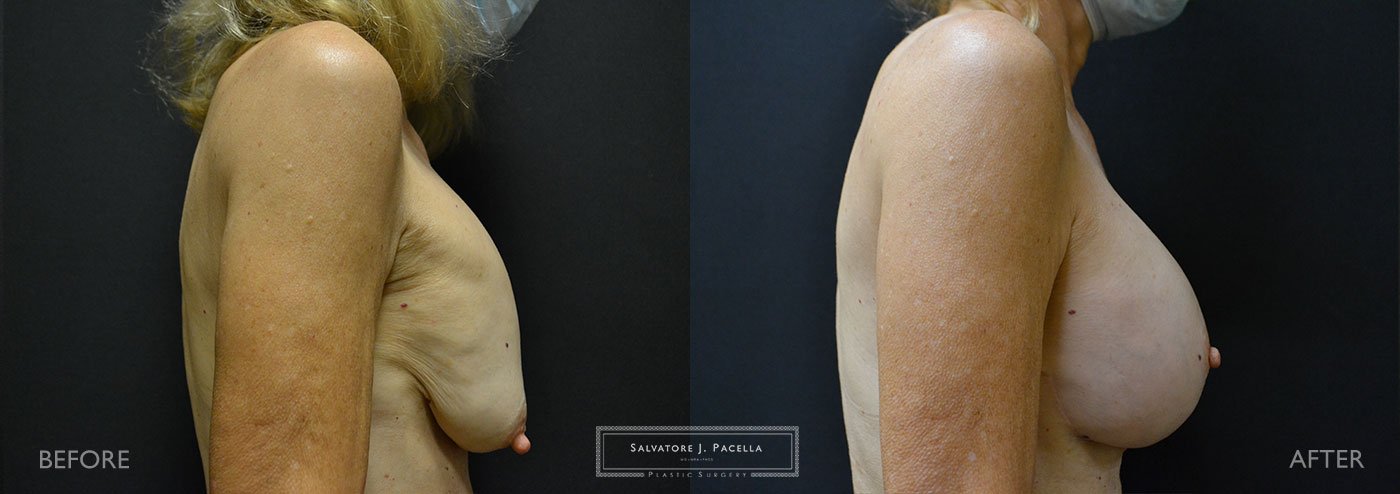 Scripps Plastic Surgeon | Plastic Surgery | Cosmetic Surgery | Breast Revision | Mastopexy | Sientra breast implants | Del Mar | San Diego | La Jolla | Breast Implants