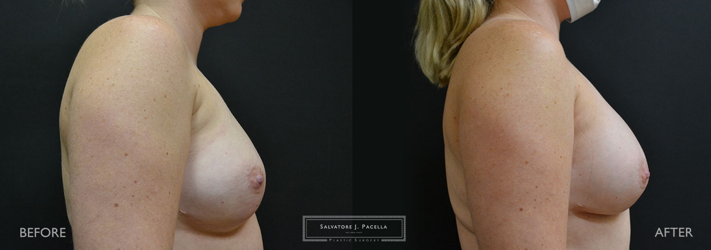 Scripps Plastic Surgeon | Plastic Surgery | Cosmetic Surgery | Breast Revision | Alloderm | Sientra breast implants | Del Mar | San Diego | La Jolla | Breast Implants