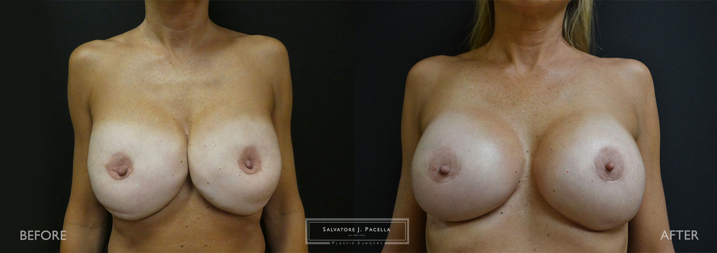 Scripps Plastic Surgeon | Plastic Surgery | Cosmetic Surgery | Breast Revision | Strattice | Del Mar | San Diego | La Jolla | Breast Implants | Mentor breast implants