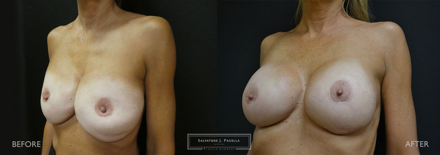 Scripps Plastic Surgeon | Plastic Surgery | Cosmetic Surgery | Breast Revision | Strattice | Del Mar | San Diego | La Jolla | Breast Implants | Mentor breast implants