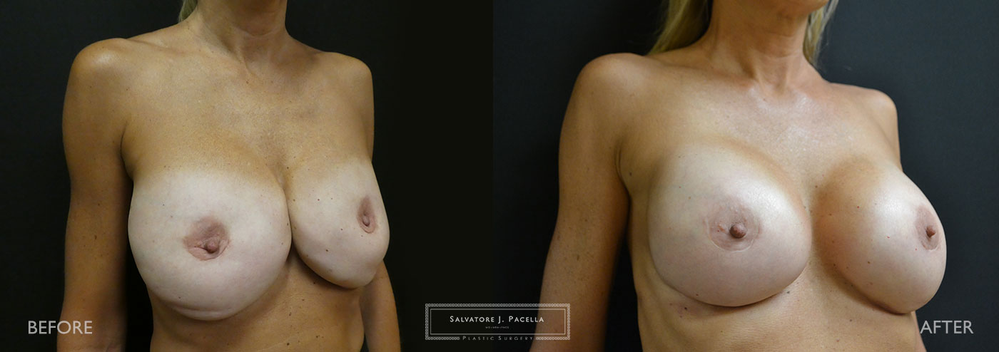 Scripps Plastic Surgeon | Plastic Surgery | Cosmetic Surgery | Breast Revision | Strattice | Del Mar | San Diego | La Jolla | Breast Implants | Mentor breast implants