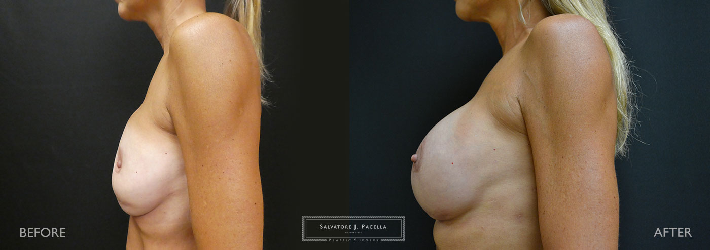 Scripps Plastic Surgeon | Plastic Surgery | Cosmetic Surgery | Breast Revision | Strattice | Del Mar | San Diego | La Jolla | Breast Implants | Mentor breast implants