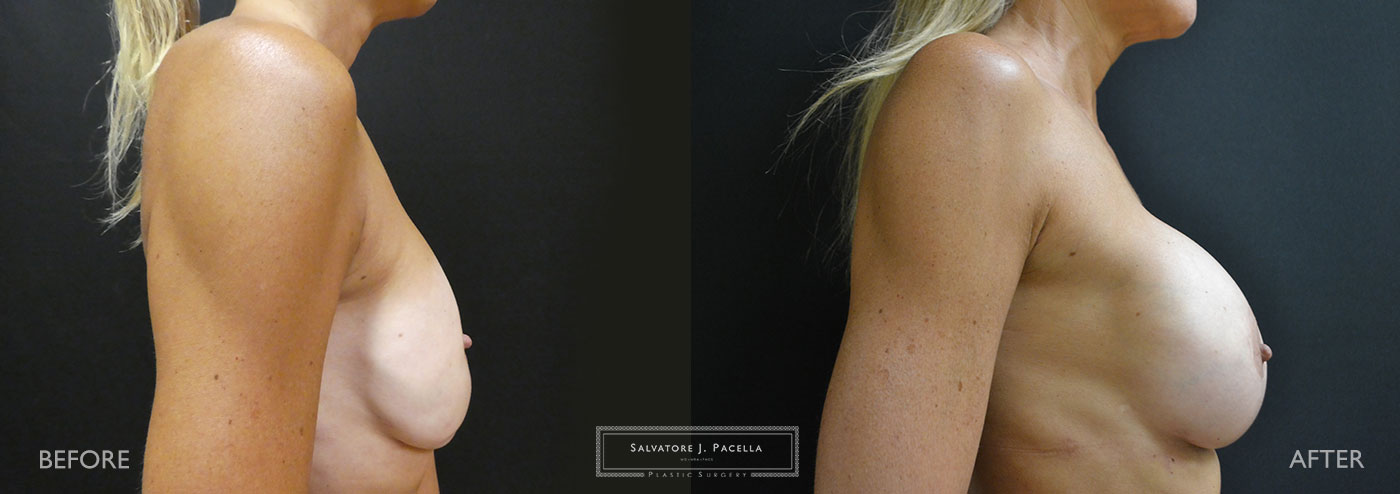 Scripps Plastic Surgeon | Plastic Surgery | Cosmetic Surgery | Breast Revision | Strattice | Del Mar | San Diego | La Jolla | Breast Implants | Mentor breast implants