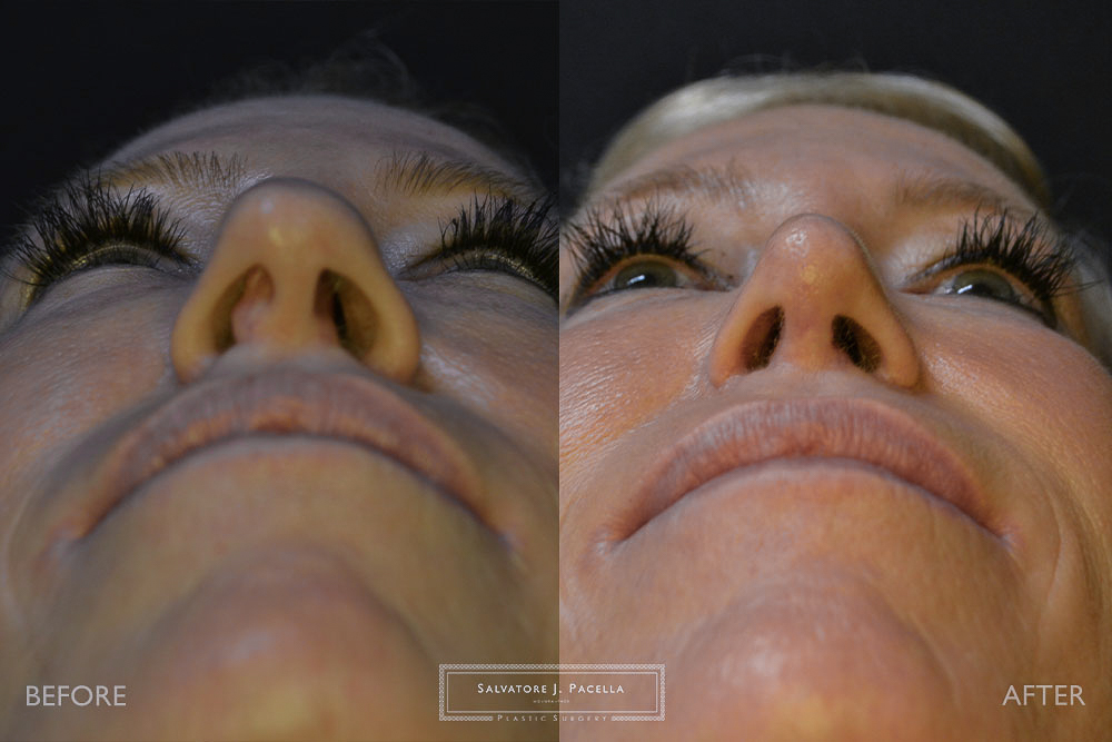 San Diego Rhinoplasty | La Jolla Rhinoplasty | Carmel Valley Rhinoplasty | Del Mar Rhinoplasty | San Diego Nose Job | La Jolla Nose Job | Carmel Valley Nose Job | Del Mar Nose Job | San Diego Chin Implant | La Jolla Chin Implant | Carmel Valley Chin Implant | Del Mar Chin Implant | San Diego Plastic Surgery | La Jolla Plastic Surgery | Carmel Valley Plastic Surgery | Del Mar Plastic Surgery | Scripps Plastic Surgeon