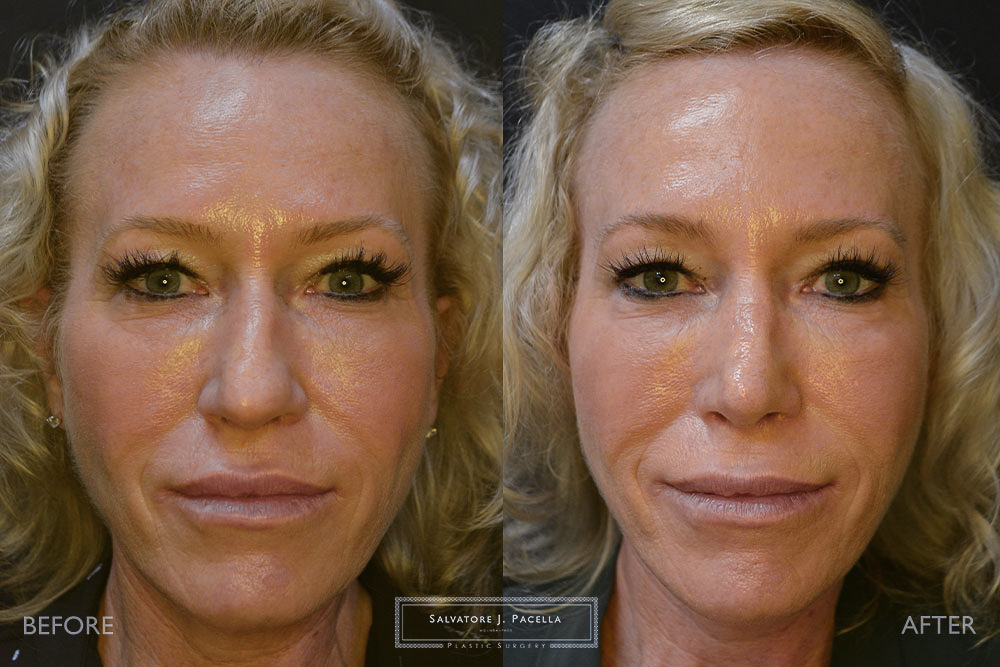 San Diego Rhinoplasty | La Jolla Rhinoplasty | Carmel Valley Rhinoplasty | Del Mar Rhinoplasty | San Diego Nose Job | La Jolla Nose Job | Carmel Valley Nose Job | Del Mar Nose Job | San Diego Chin Implant | La Jolla Chin Implant | Carmel Valley Chin Implant | Del Mar Chin Implant | San Diego Plastic Surgery | La Jolla Plastic Surgery | Carmel Valley Plastic Surgery | Del Mar Plastic Surgery | Scripps Plastic Surgeon