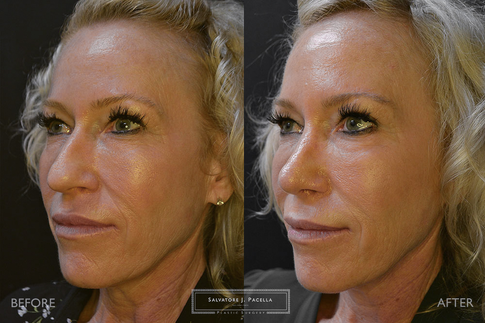 San Diego Rhinoplasty | La Jolla Rhinoplasty | Carmel Valley Rhinoplasty | Del Mar Rhinoplasty | San Diego Nose Job | La Jolla Nose Job | Carmel Valley Nose Job | Del Mar Nose Job | San Diego Chin Implant | La Jolla Chin Implant | Carmel Valley Chin Implant | Del Mar Chin Implant | San Diego Plastic Surgery | La Jolla Plastic Surgery | Carmel Valley Plastic Surgery | Del Mar Plastic Surgery | Scripps Plastic Surgeon