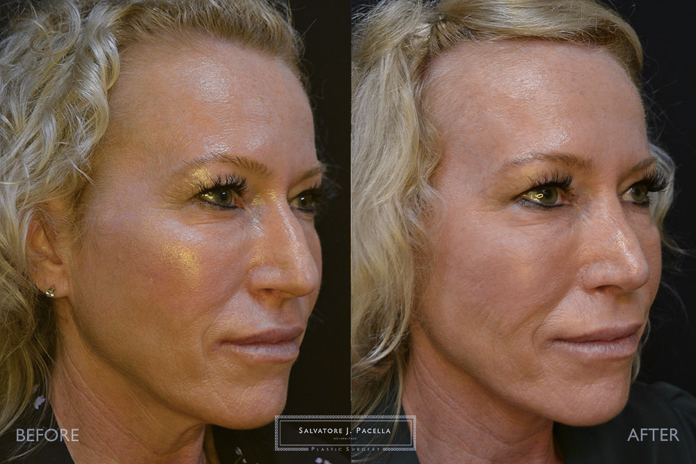 San Diego Rhinoplasty | La Jolla Rhinoplasty | Carmel Valley Rhinoplasty | Del Mar Rhinoplasty | San Diego Nose Job | La Jolla Nose Job | Carmel Valley Nose Job | Del Mar Nose Job | San Diego Chin Implant | La Jolla Chin Implant | Carmel Valley Chin Implant | Del Mar Chin Implant | San Diego Plastic Surgery | La Jolla Plastic Surgery | Carmel Valley Plastic Surgery | Del Mar Plastic Surgery | Scripps Plastic Surgeon