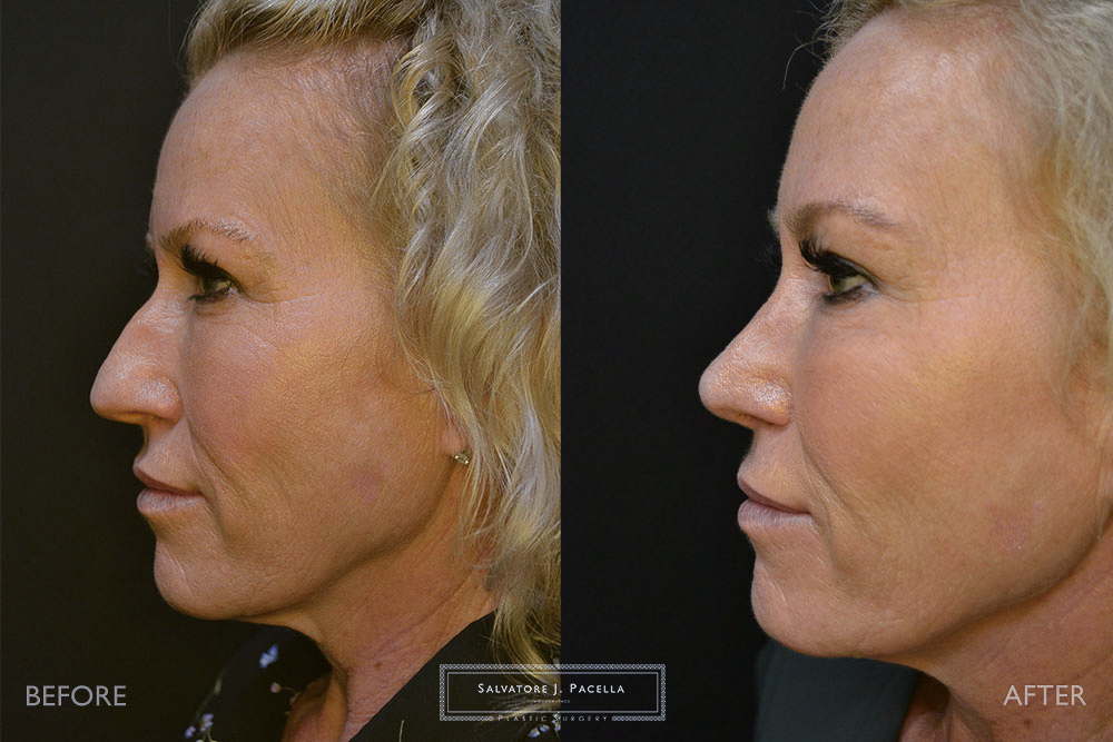 San Diego Rhinoplasty | La Jolla Rhinoplasty | Carmel Valley Rhinoplasty | Del Mar Rhinoplasty | San Diego Nose Job | La Jolla Nose Job | Carmel Valley Nose Job | Del Mar Nose Job | San Diego Chin Implant | La Jolla Chin Implant | Carmel Valley Chin Implant | Del Mar Chin Implant | San Diego Plastic Surgery | La Jolla Plastic Surgery | Carmel Valley Plastic Surgery | Del Mar Plastic Surgery | Scripps Plastic Surgeon