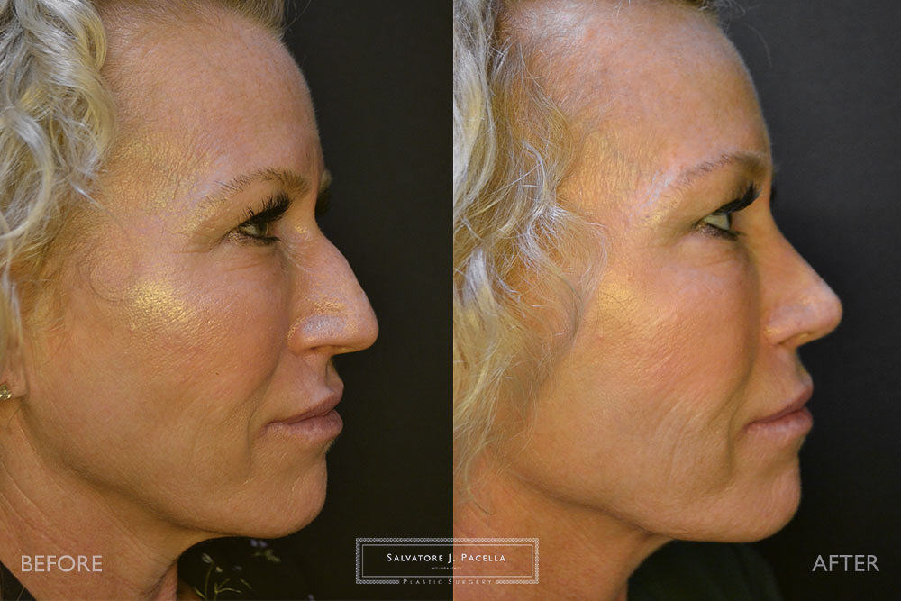 San Diego Rhinoplasty | La Jolla Rhinoplasty | Carmel Valley Rhinoplasty | Del Mar Rhinoplasty | San Diego Nose Job | La Jolla Nose Job | Carmel Valley Nose Job | Del Mar Nose Job | San Diego Chin Implant | La Jolla Chin Implant | Carmel Valley Chin Implant | Del Mar Chin Implant | San Diego Plastic Surgery | La Jolla Plastic Surgery | Carmel Valley Plastic Surgery | Del Mar Plastic Surgery | Scripps Plastic Surgeon
