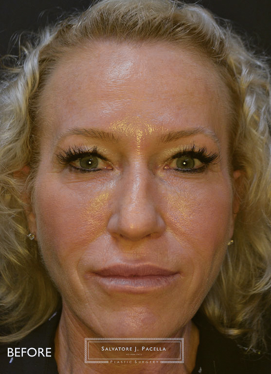 San Diego Rhinoplasty | La Jolla Rhinoplasty | Carmel Valley Rhinoplasty | Del Mar Rhinoplasty | San Diego Nose Job | La Jolla Nose Job | Carmel Valley Nose Job | Del Mar Nose Job | San Diego Chin Implant | La Jolla Chin Implant | Carmel Valley Chin Implant | Del Mar Chin Implant | San Diego Plastic Surgery | La Jolla Plastic Surgery | Carmel Valley Plastic Surgery | Del Mar Plastic Surgery | Scripps Plastic Surgeon