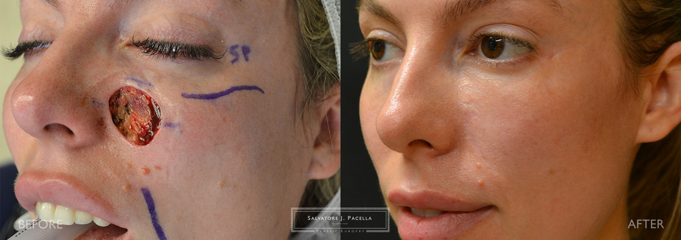 San Diego mohs surgery | La Jolla mohs surgery | Carmel Valley mohs surgery | Del Mar mohs surgery | San Diego Plastic Surgery | La Jolla Plastic Surgery | Carmel Valley Plastic Surgery | Del Mar Plastic Surgery