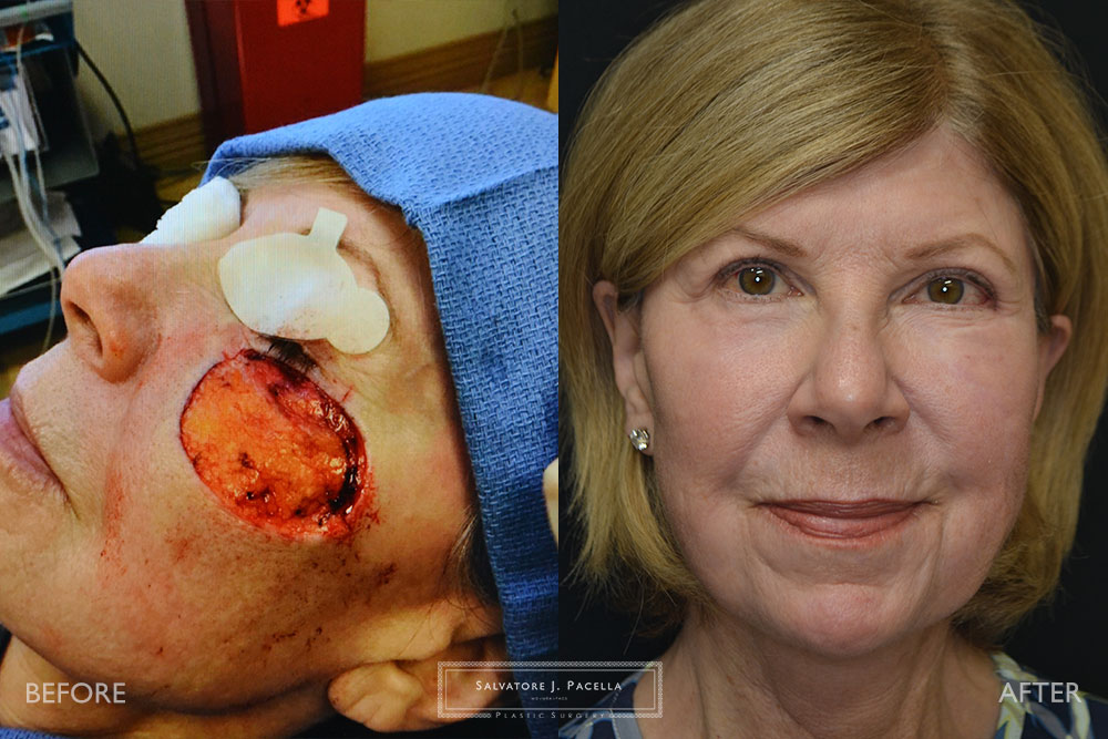 San Diego | La Jolla | Carmel Valley | Del Mar | Dr Pacella Best Plastic Surgeon | Canthopexy | Mohs Surgery | Plastic Surgery