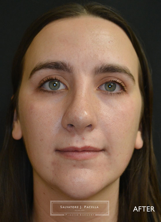 San Diego | La Jolla | Carmel Valley | Del Mar | Scripps Plastic Surgeon | Rhinoplasty | Nose Job | Chin Implant | Plastic Surgery | Best Plastic Surgeon