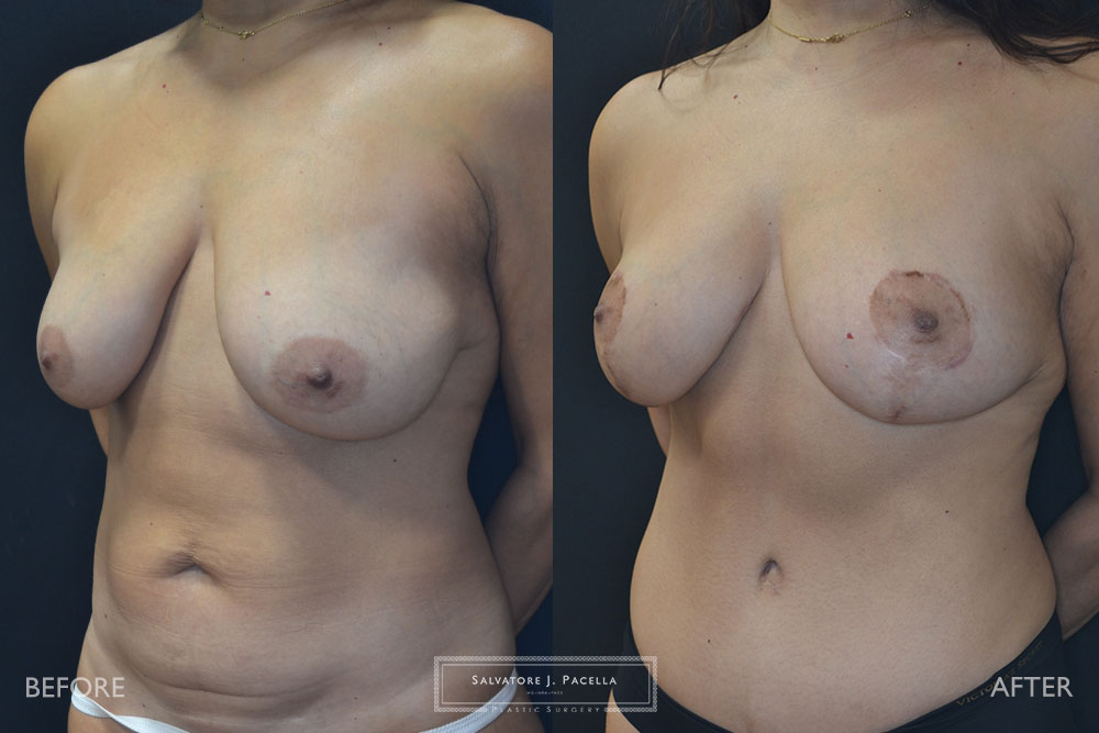 San Diego | La Jolla | Carmel Valley | Del Mar | Encinitas | Plastic Surgery | Body Contouring | Tummy Tuck | Mommy Makeover | Boob Job | Breast Augmentation | Top Plastic Surgeon