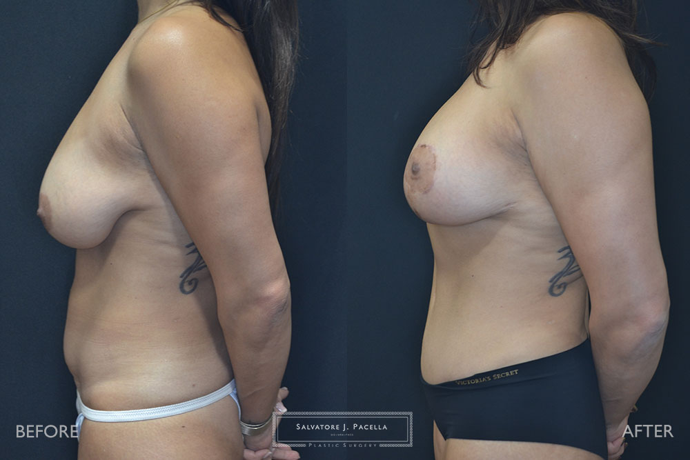 San Diego | La Jolla | Carmel Valley | Del Mar | Encinitas | Plastic Surgery | Body Contouring | Tummy Tuck | Mommy Makeover | Boob Job | Breast Augmentation | Top Plastic Surgeon