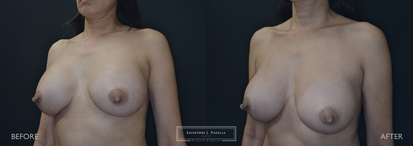 Scripps Plastic Surgeon | Plastic Surgery | Cosmetic Surgery | Breast Revision | Mastopexy | Mentor breast implants | San Diego | La Jolla | Breast Implants | Del Mar