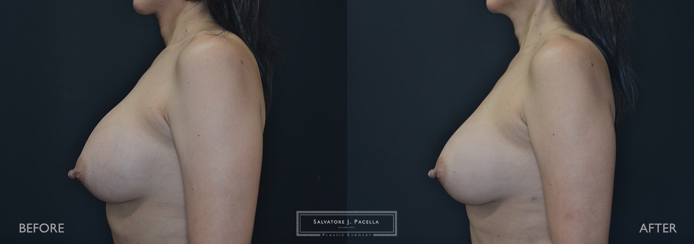 Scripps Plastic Surgeon | Plastic Surgery | Cosmetic Surgery | Breast Revision | Mastopexy | Mentor breast implants | San Diego | La Jolla | Breast Implants | Del Mar