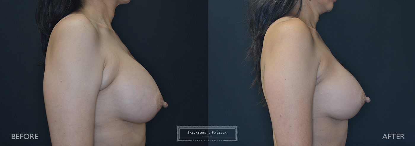 Scripps Plastic Surgeon | Plastic Surgery | Cosmetic Surgery | Breast Revision | Mastopexy | Mentor breast implants | San Diego | La Jolla | Breast Implants | Del Mar