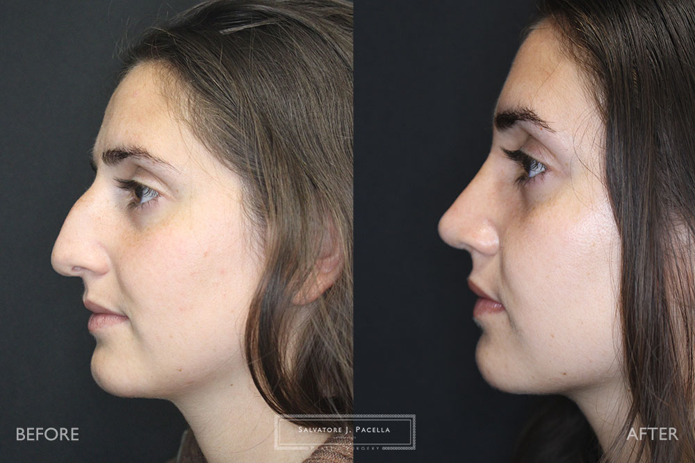 San Diego Rhinoplasty | La Jolla Rhinoplasty | Carmel Valley Rhinoplasty | Del Mar Rhinoplasty | San Diego Nose Job | La Jolla Nose Job | Carmel Valley Nose Job | Del Mar Nose Job | San Diego Chin Implant | La Jolla Chin Implant | Carmel Valley Chin Implant | Del Mar Chin Implant | San Diego Plastic Surgery | La Jolla Plastic Surgery | Carmel Valley Plastic Surgery | Del Mar Plastic Surgery | Scripps Plastic Surgeon