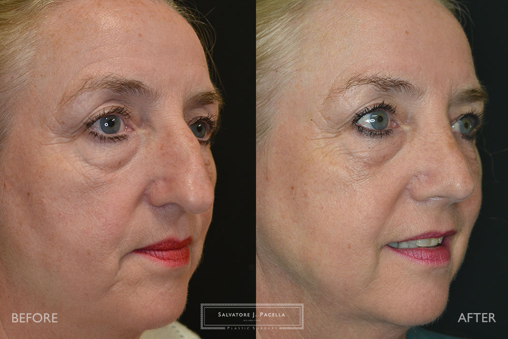 San Diego Rhinoplasty | La Jolla Rhinoplasty | Carmel Valley Rhinoplasty | Del Mar Rhinoplasty | San Diego Nose Job | La Jolla Nose Job | Carmel Valley Nose Job | Del Mar Nose Job | San Diego Chin Implant | La Jolla Chin Implant | Carmel Valley Chin Implant | Del Mar Chin Implant | San Diego Plastic Surgery | La Jolla Plastic Surgery | Carmel Valley Plastic Surgery | Del Mar Plastic Surgery | Scripps Plastic Surgeon