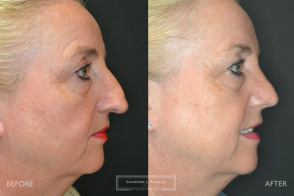 San Diego Rhinoplasty | La Jolla Rhinoplasty | Carmel Valley Rhinoplasty | Del Mar Rhinoplasty | San Diego Nose Job | La Jolla Nose Job | Carmel Valley Nose Job | Del Mar Nose Job | San Diego Chin Implant | La Jolla Chin Implant | Carmel Valley Chin Implant | Del Mar Chin Implant | San Diego Plastic Surgery | La Jolla Plastic Surgery | Carmel Valley Plastic Surgery | Del Mar Plastic Surgery | Scripps Plastic Surgeon